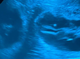 Ultrasound to confirm pregnancy