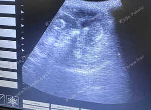 Pregnancy confirmation scanning