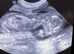 Mobile ultrasounds