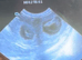 Confirmed pregnancy