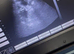 Pregnancy confirmation scanning