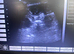 Pregnancy confirmation scanning